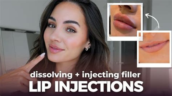 Did She Get Lip Injections? — Expert Speaks – Hollywood Life