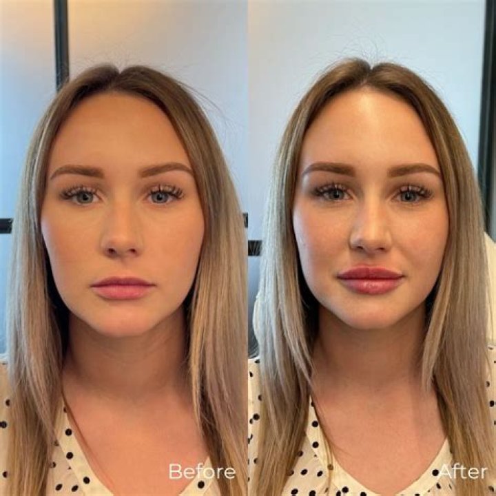 Farrah Abraham Reveals She’s Had Her Lip Fillers Removed Just Like Kylie Jenner — Before & After Pics