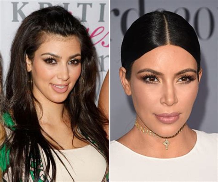 Get Rid Of Your Unwanted Hair With A New Laser Like Kim Kardashian