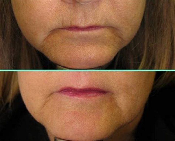 The New Way To Erase Annoying Lines Around Your Lips — Dermatologist Shares Advice
